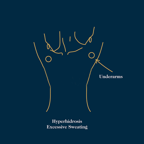 Botox for Hyperhidrosis Excessive Sweating