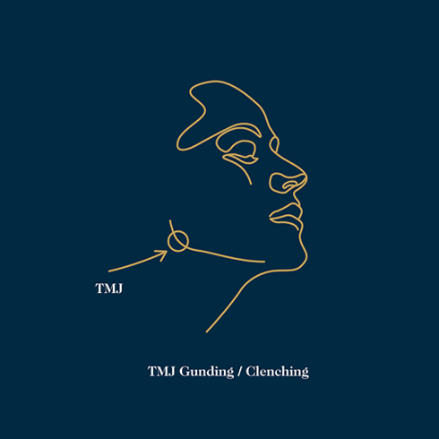 TMJ Grinding/Clenching